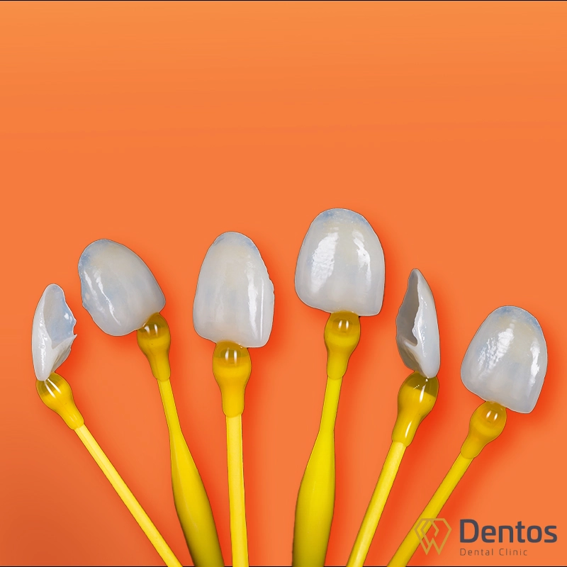 Miếng dán sứ veneer siêu mỏng nên chỉ cần mài rất ít men răng